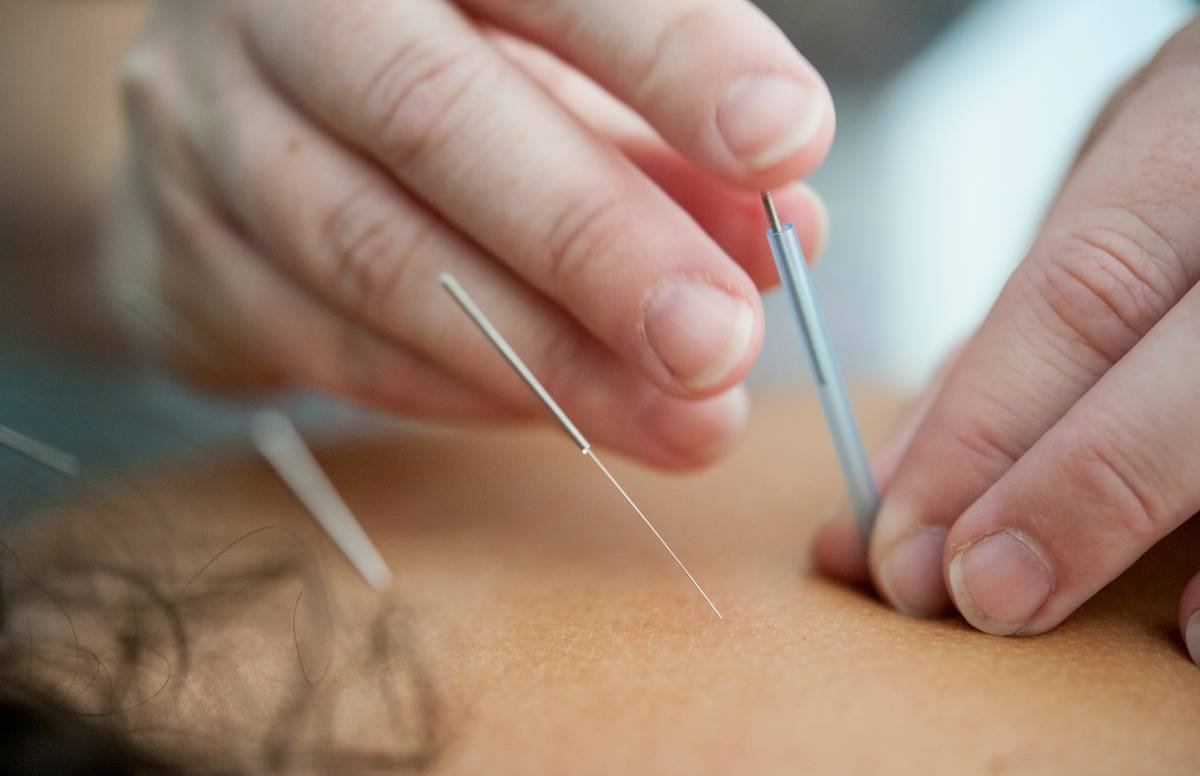 How Slim Needles Clinic is Revolutionizing Weight Loss with Acupuncture