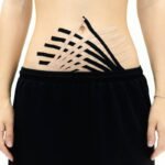 Acupuncture for Weight Loss: How Slim Needles for Thigh Fat Can Help